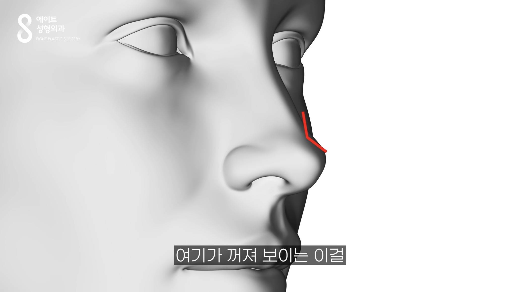 요즘 중국에서 유행이라는 코수술 모양.jpg | 인스티즈