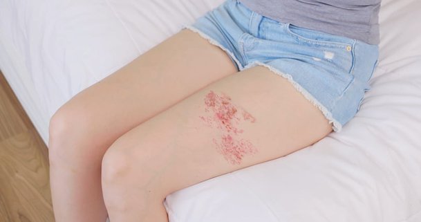 성관계 후 증상 없었는데…한국도 '폭증' 무슨 병이길래? | 인스티즈