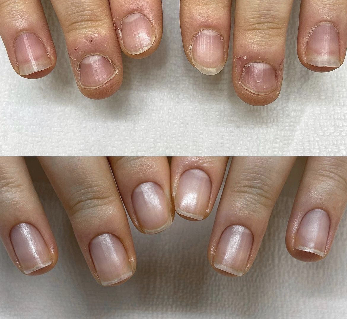 손톱 교정 비포/애프터 | 인스티즈