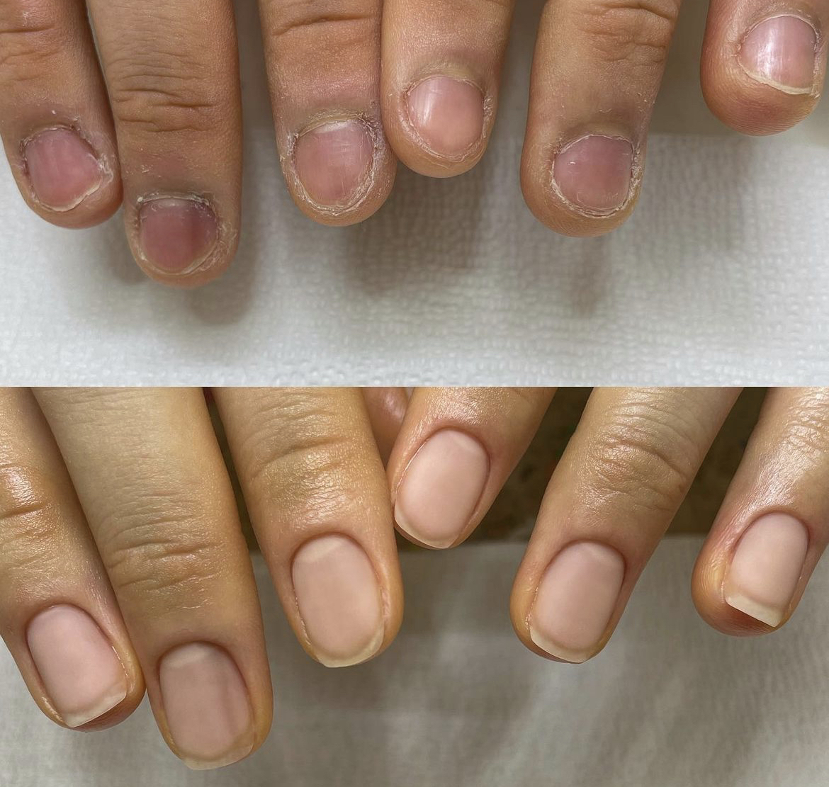 손톱 교정 비포/애프터 | 인스티즈