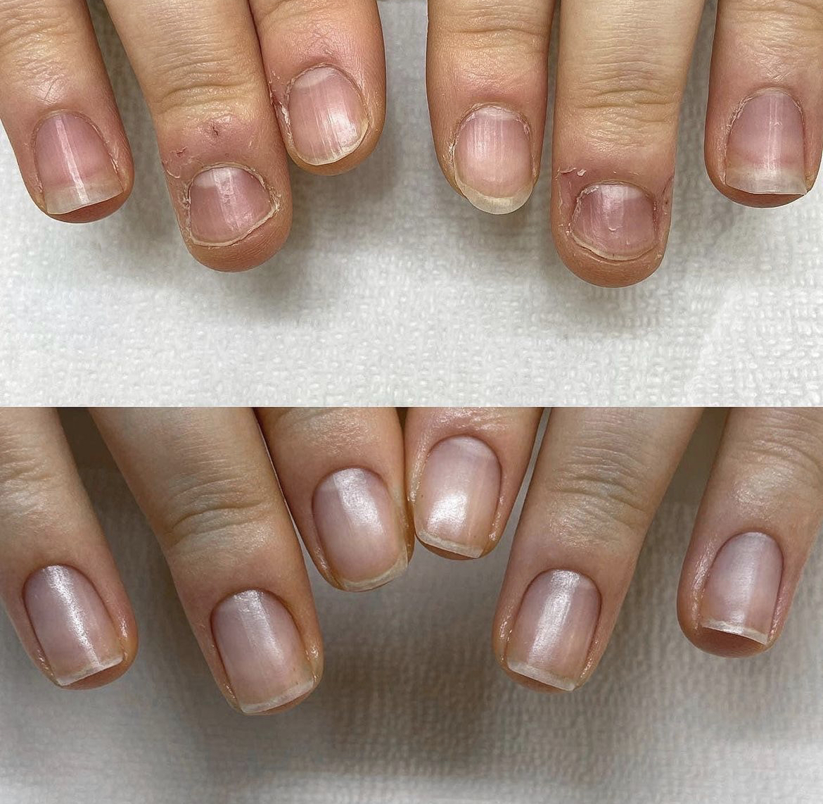 손톱 교정 비포/애프터 | 인스티즈