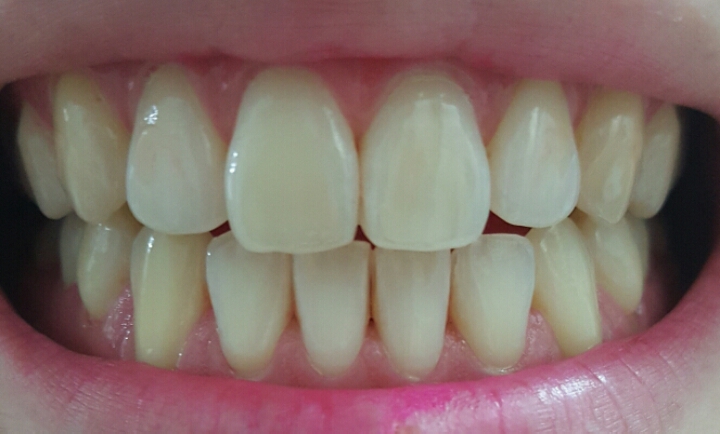 내가 얼마나 이를 잘 닦고 있나... 치면착색제 사용 후기 | 인스티즈