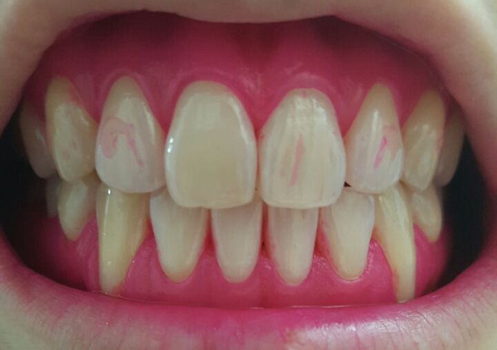 내가 얼마나 이를 잘 닦고 있나... 치면착색제 사용 후기 | 인스티즈