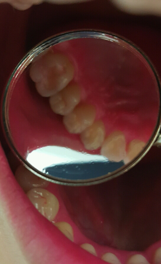 내가 얼마나 이를 잘 닦고 있나... 치면착색제 사용 후기 | 인스티즈