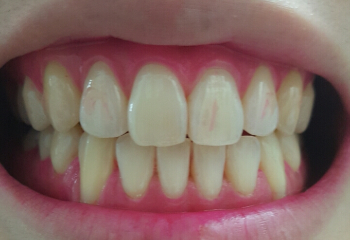 내가 얼마나 이를 잘 닦고 있나... 치면착색제 사용 후기 | 인스티즈