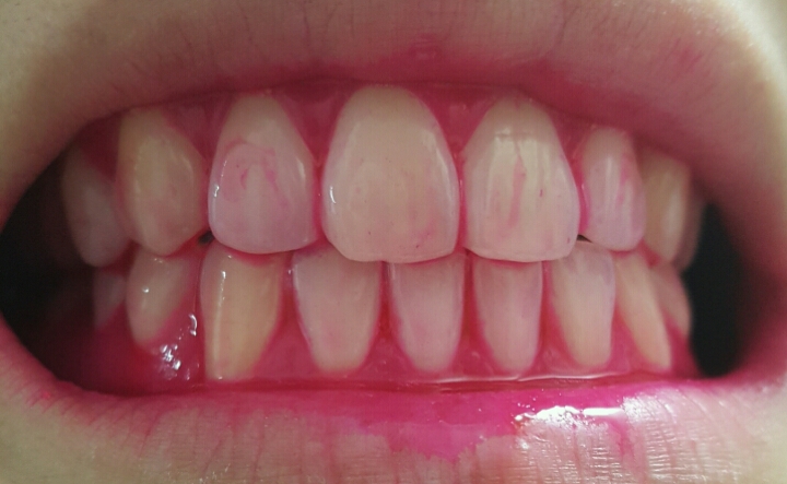 내가 얼마나 이를 잘 닦고 있나... 치면착색제 사용 후기 | 인스티즈