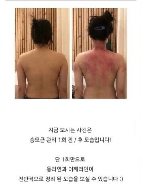 승모근 교정 후기 | 인스티즈