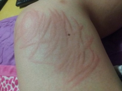 우리나라 5%가 가지고있다는 피부병 | 인스티즈