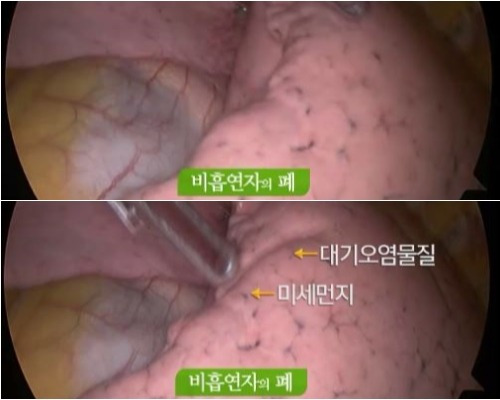 비흡연자, 간접흡연, 흡연자 폐 사진 | 인스티즈