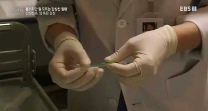 실제 갑상선 혹 조직검사 | 인스티즈