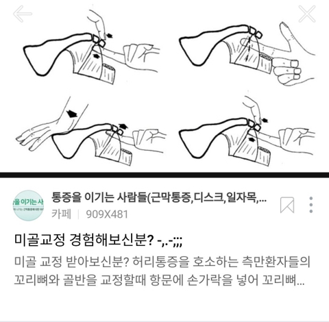 항문에 직접 손을 넣어서 척추를 교정한다는 '미골 교정' .twt | 인스티즈
