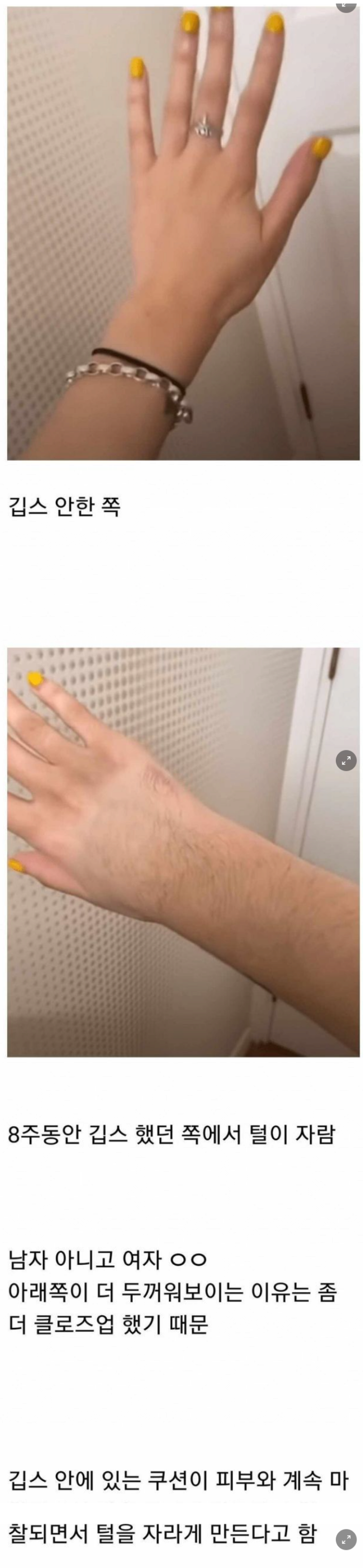  깁스 풀고 난 여자의 후유증.JPG1