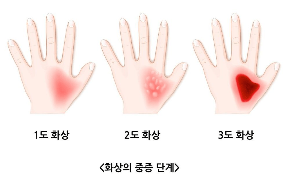 화상이 얼마나 심각한 부상이고 치료에 어떤 과정이 필요할까? | 인스티즈