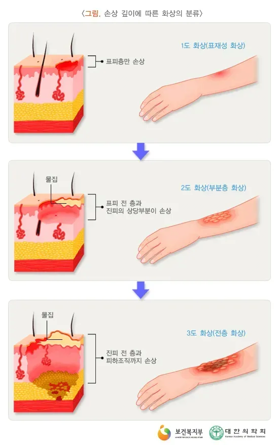 화상이 얼마나 심각한 부상이고 치료에 어떤 과정이 필요할까? | 인스티즈