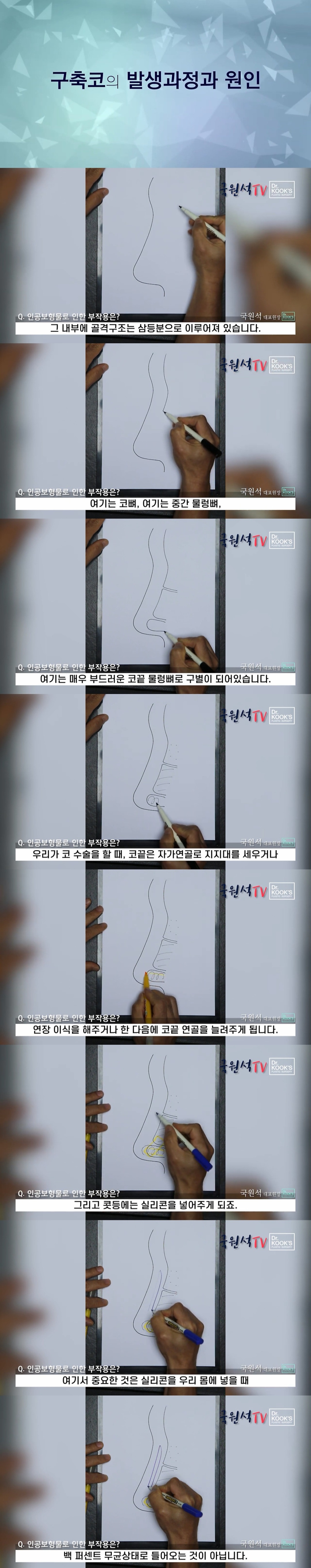  코 성형 후 구축이 생기는 과정