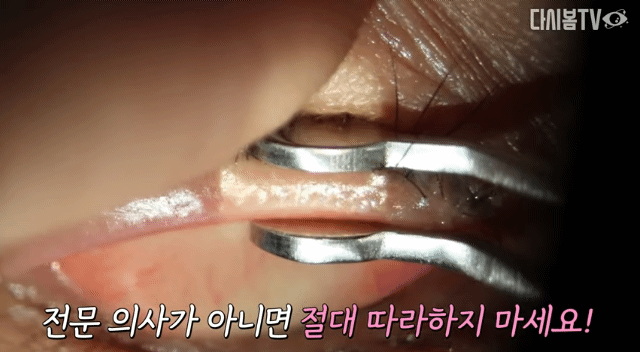  눈 기름샘 마이봄샘 피지 짜기.gif