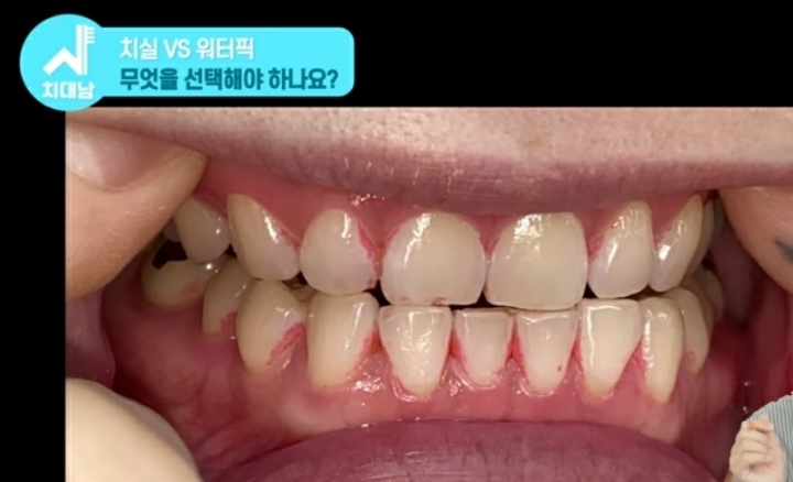 치실 대신 워터픽 쓰면 안됨? 워터픽 이름이 물치실이잖아 | 인스티즈