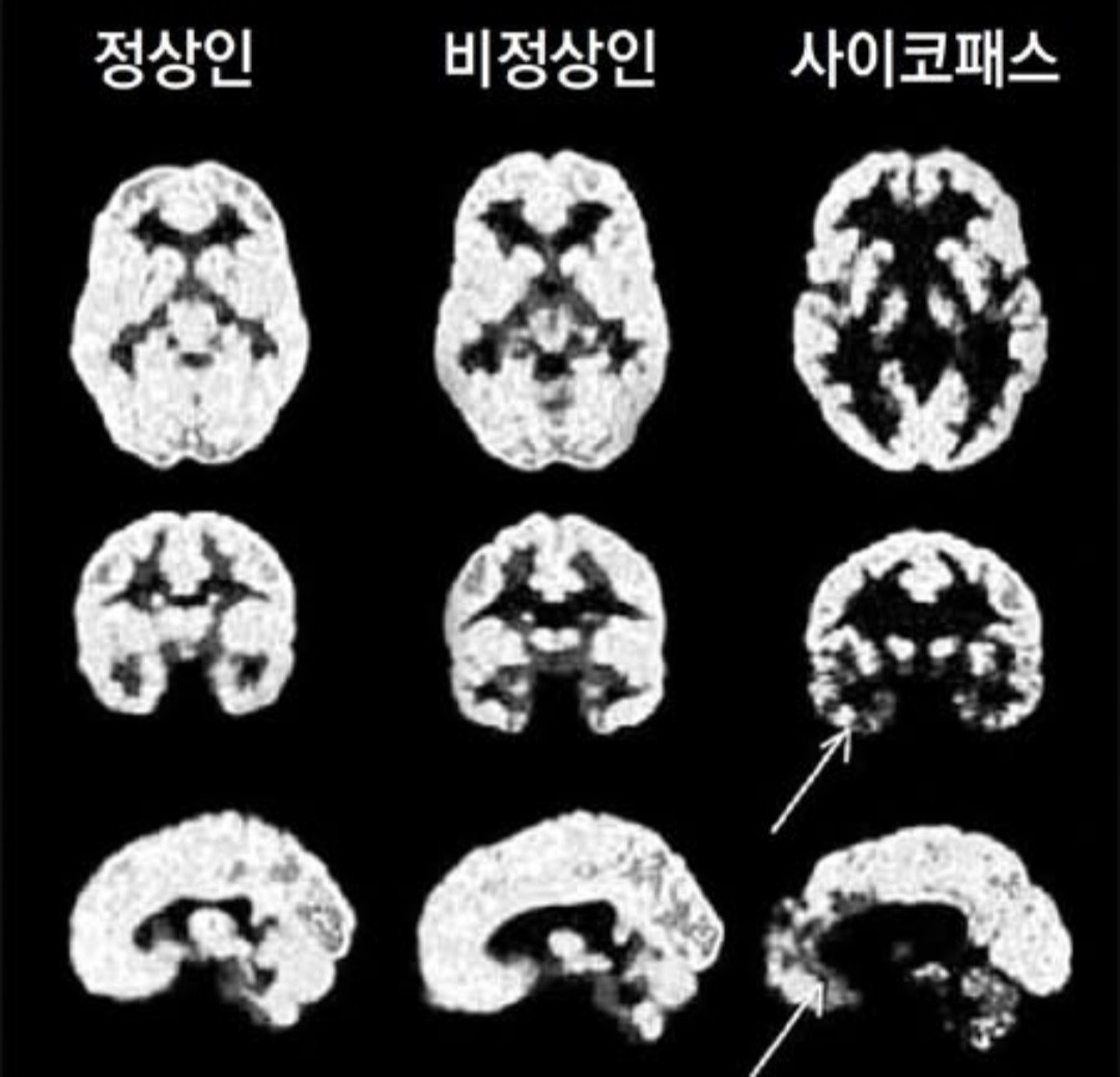  정상인 비정상인 싸패의 뇌구조 차이