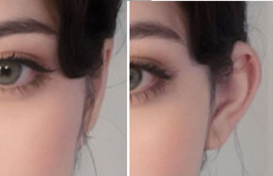 누워 있던 귀가 벌떡? 테이프 붙이고 성형까지 | 인스티즈