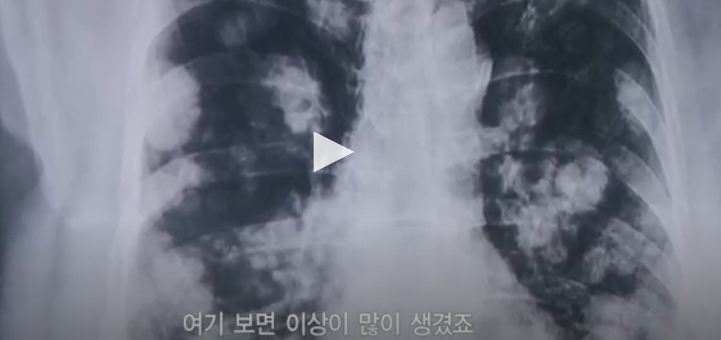[충격] 전자담배는 충분히 해로움 | 인스티즈