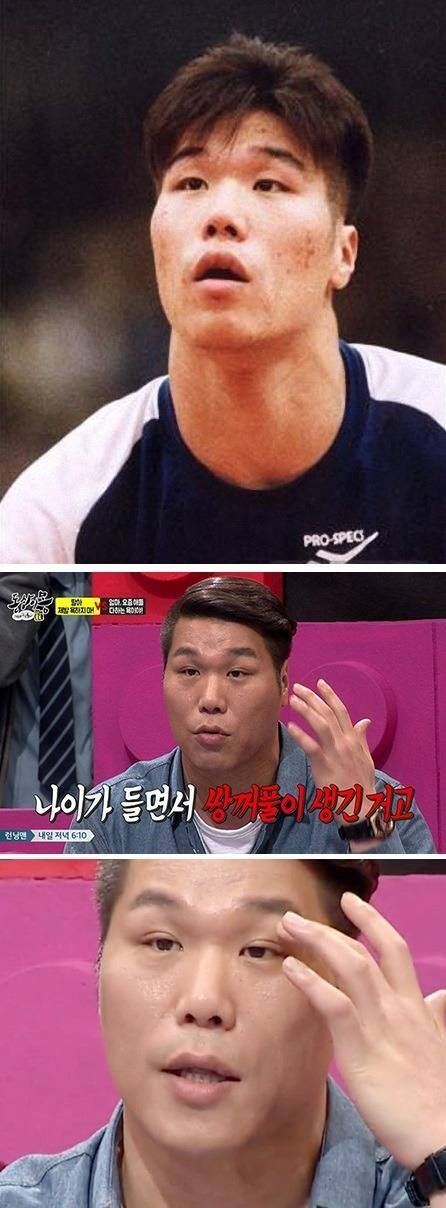  은근히 많이 생긴다는 &apos;후천적 쌍꺼풀&apos;1