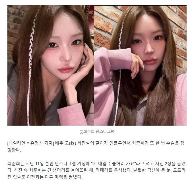  또 수술하러 간다 최준희, 몰라보게 달라진 얼굴…과거 앓았던 &apos;루푸스&apos; 어떤 병..