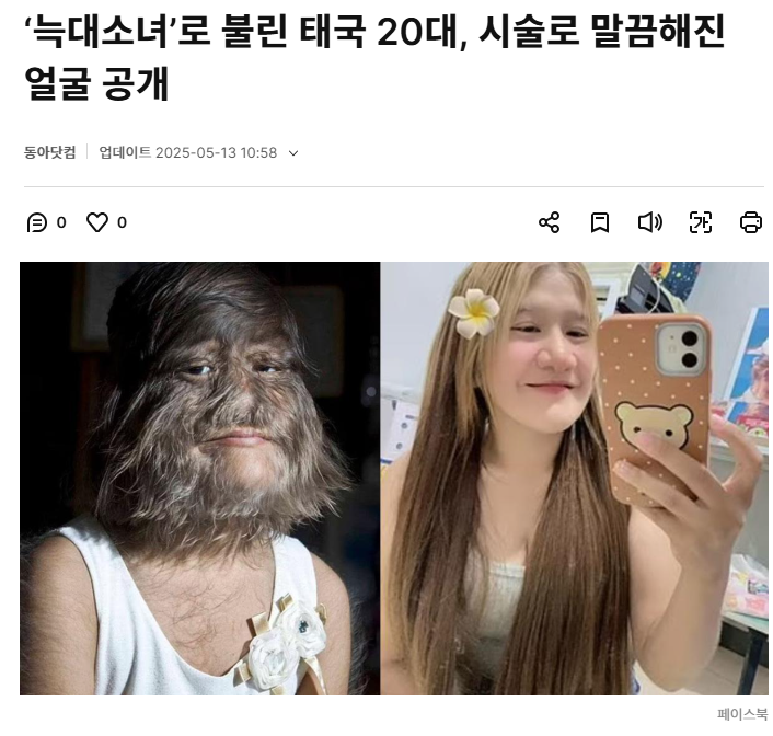  &apos;늑대소녀&apos;로 불린 태국 20대, 시술로 말끔해진 얼굴 공개1