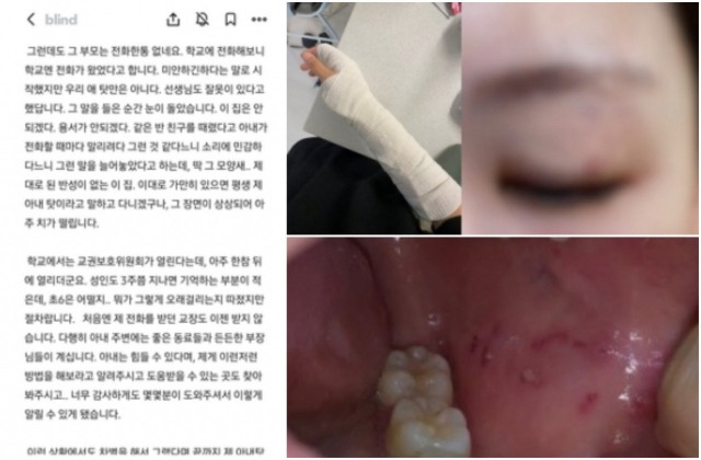 6학년男 발길질에 피멍 든 &apos;전치 3주&apos; 女교사, 학부모 상대로 소송전2