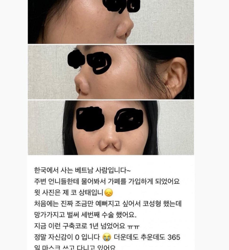 한국에서 코 성형한 베트남 사람