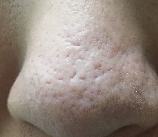 약혐주의) 코 모공 패임 흉터 | 인스티즈