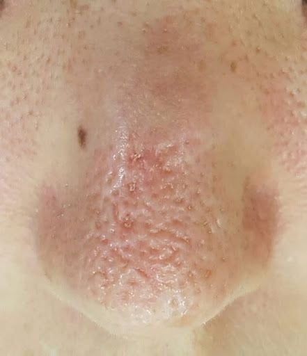 약혐주의) 코 모공 패임 흉터 | 인스티즈