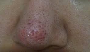 약혐주의) 코 모공 패임 흉터 | 인스티즈