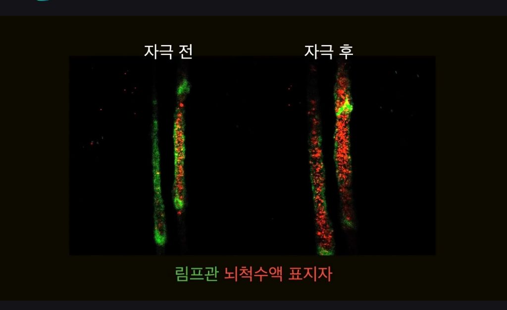 뇌 노폐물, 마사지로 빼낸다…"치매 예방에 효과” | 인스티즈