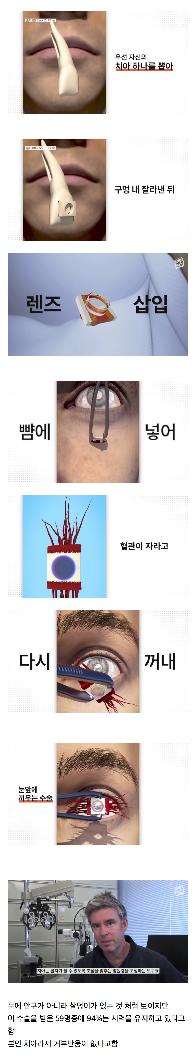 시각장애인의 눈에 치아를 넣어 시력을 회복하는 수술.jpg