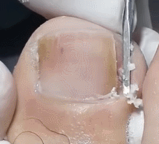 혐주의) 내성발톱 제거 장면 | 인스티즈