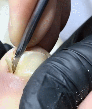 혐주의) 내성발톱 제거 장면 | 인스티즈