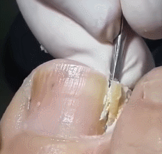 혐주의) 내성발톱 제거 장면 | 인스티즈