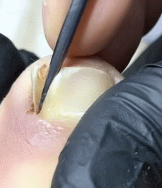 혐주의) 내성발톱 제거 장면 | 인스티즈