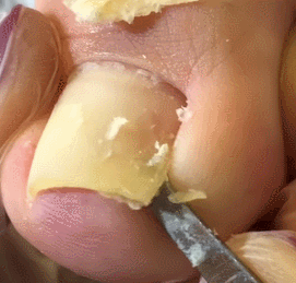 혐주의) 내성발톱 제거 장면 | 인스티즈