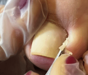 혐주의) 내성발톱 제거 장면 | 인스티즈