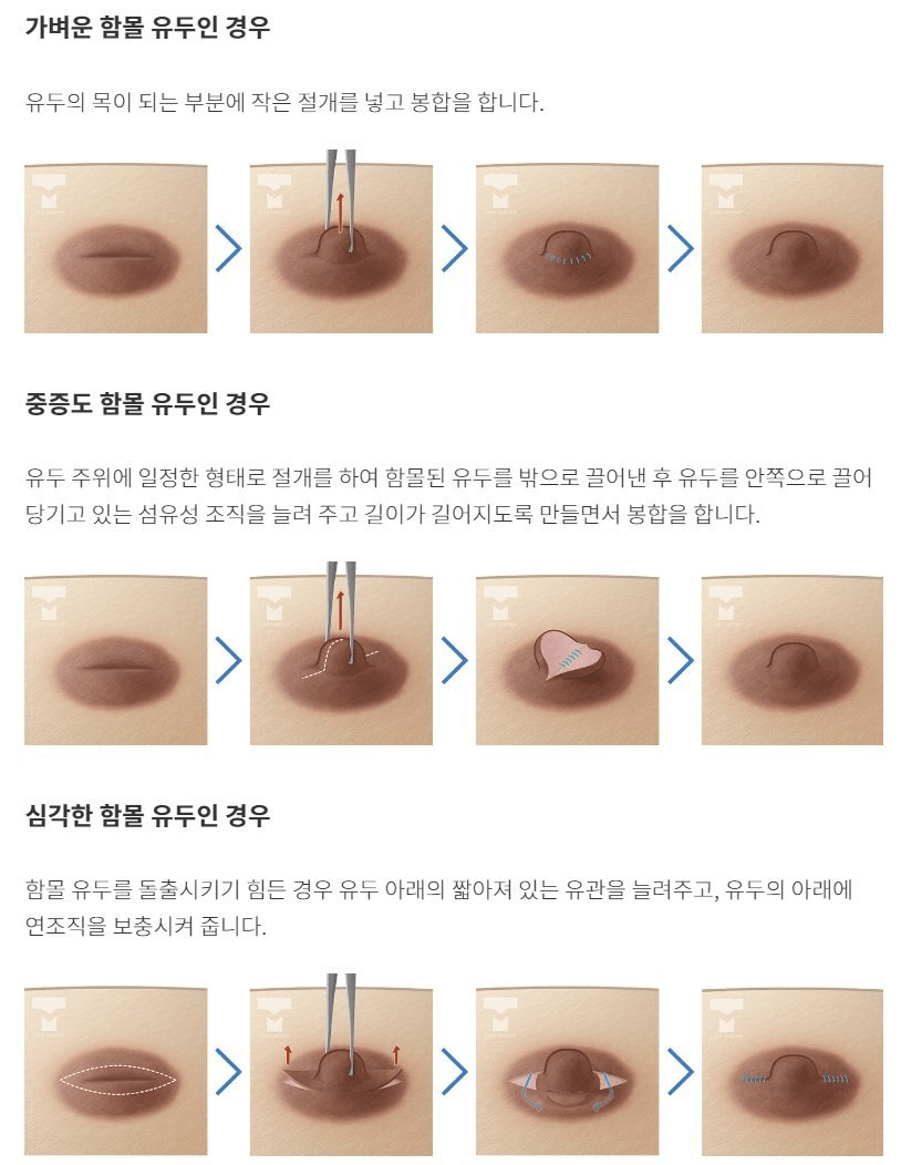 다양한 유두성형 기술 | 인스티즈