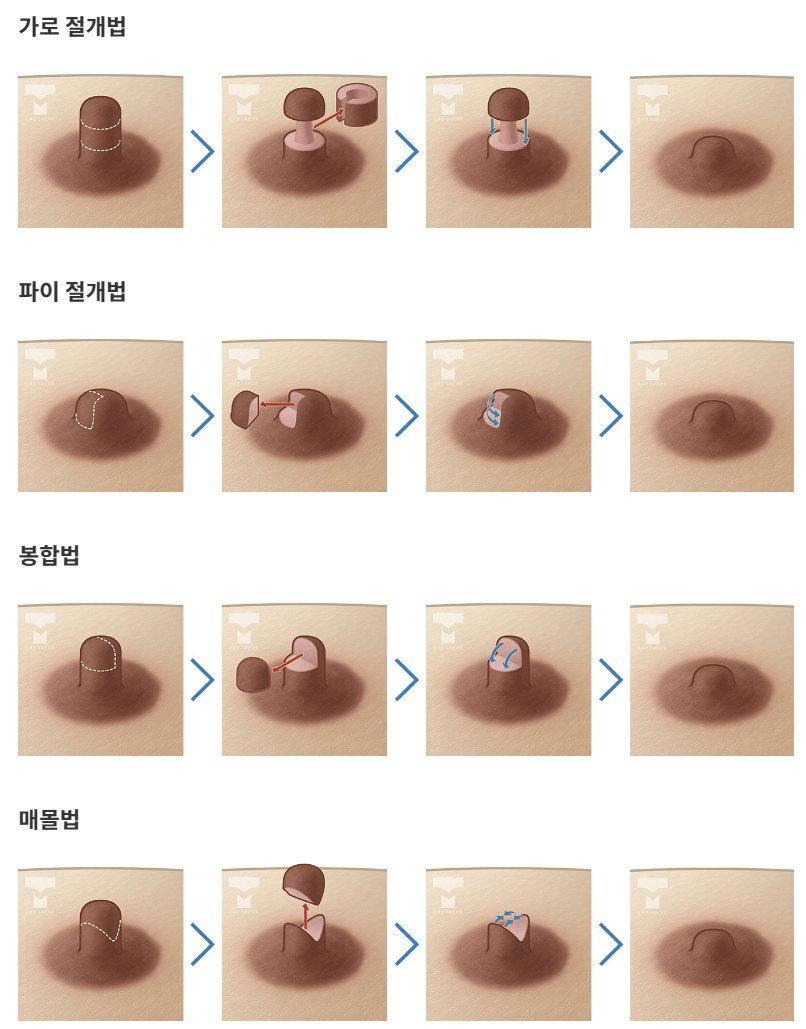 다양한 유두성형 기술 | 인스티즈