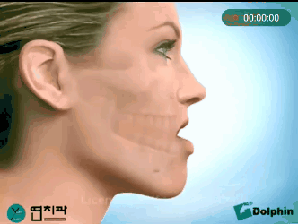 미용성형이 아닌데 한때 열풍처럼 유행했던 수술.gif | 인스티즈