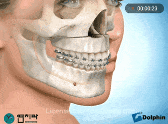 미용성형이 아닌데 한때 열풍처럼 유행했던 수술.gif | 인스티즈