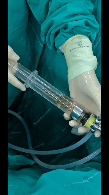 쭈압쭈압 요로결석 빼는 과정.gif | 인스티즈