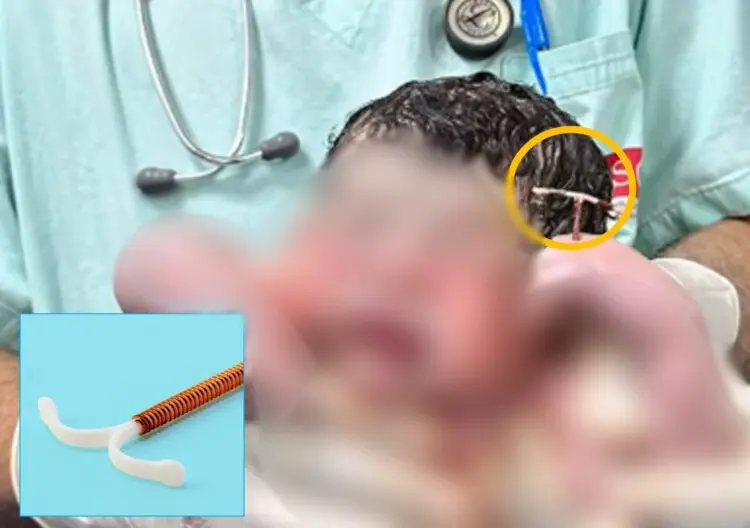 손에 피임장치 쥐고 태어난 아기.jpg | 인스티즈