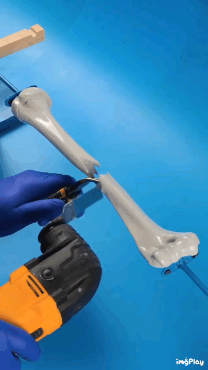 키 크는 수술 원리 | 인스티즈