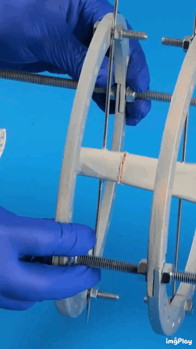 키 크는 수술 원리 | 인스티즈