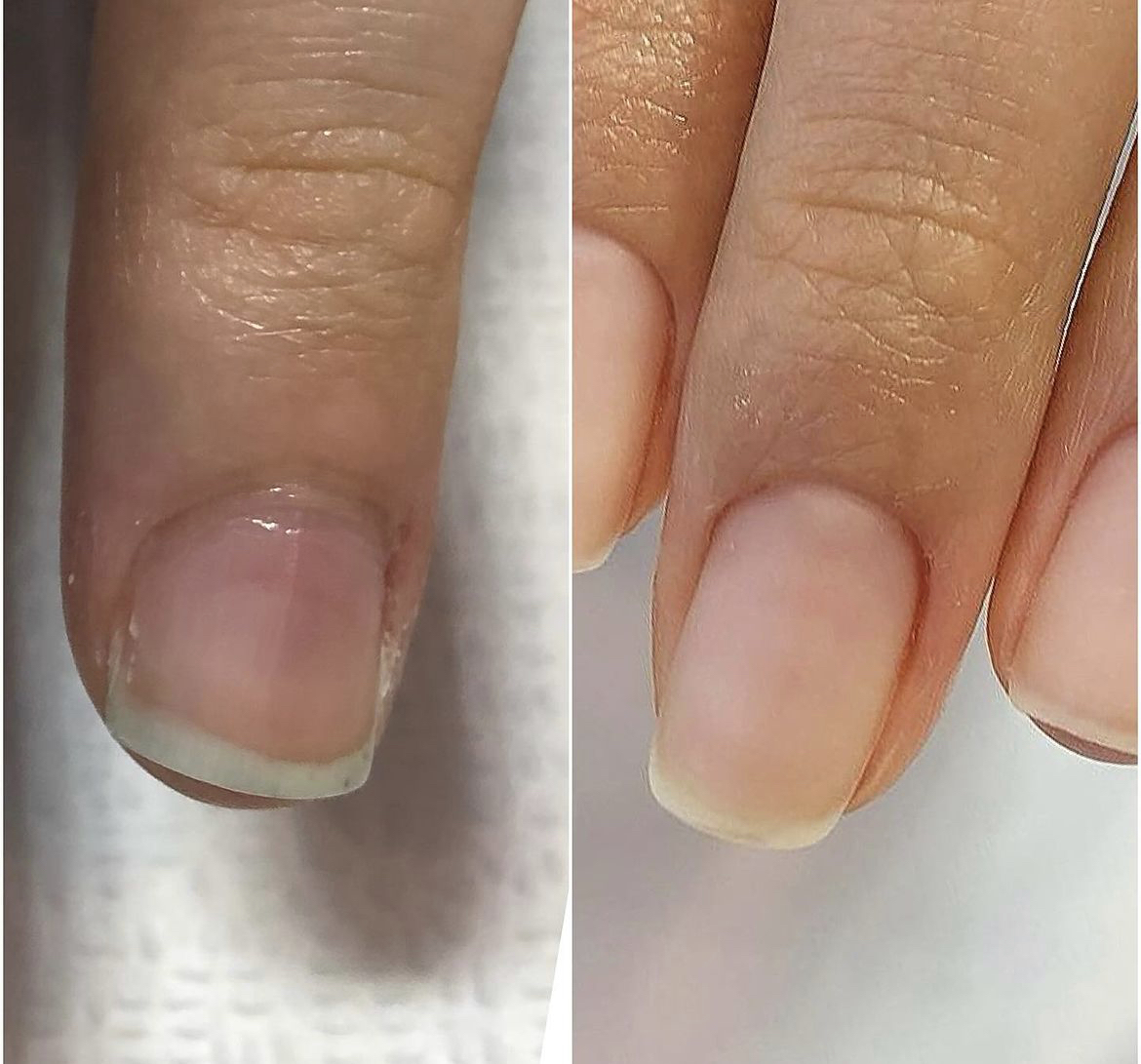 손톱 교정 비포/애프터 | 인스티즈