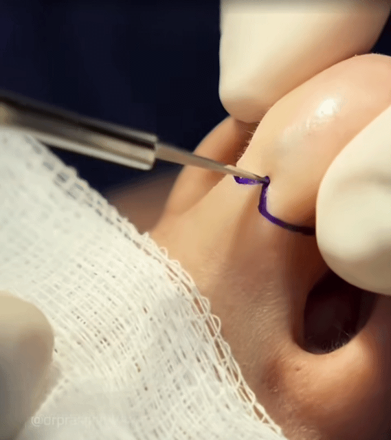 코필러 시술한 환자 필러를 다시 제거하는 장면 (혐) | 인스티즈